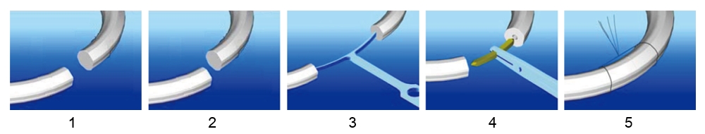 Operating Instructions for Absorbable Rib Nail