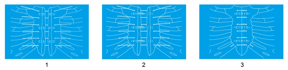 Operating Instructions for Absorbable Sternum Nail