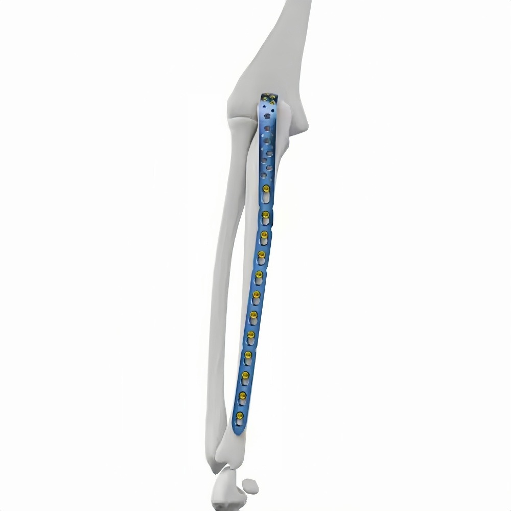 Olecranon Locking Plate