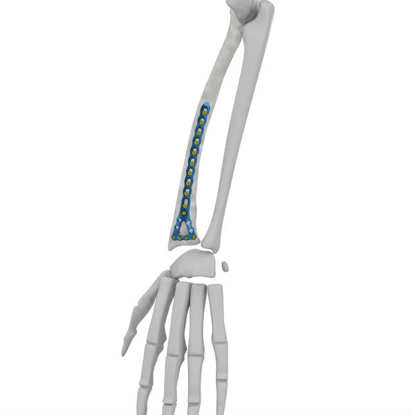 Distal Radius Locking Plate