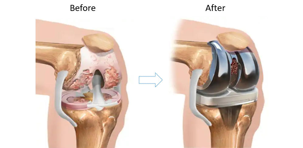 Total Knee Replacement