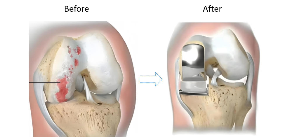  Partial Knee Replacement