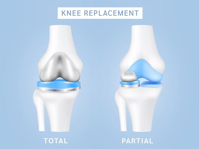 Difference Between Total Knee Replacement and Partial Knee Replacement: A Complete Guide